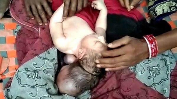 Kelahiran Bayi Berkepala Tiga Bikin Heboh, Dianggap Jelmaan Dewa oleh Warga India