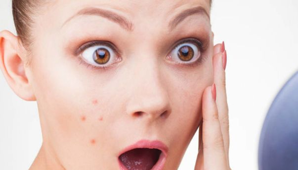 Ladies, Begini Cara Mengatasi Jerawat yang Muncul Sebelum Menstruasi