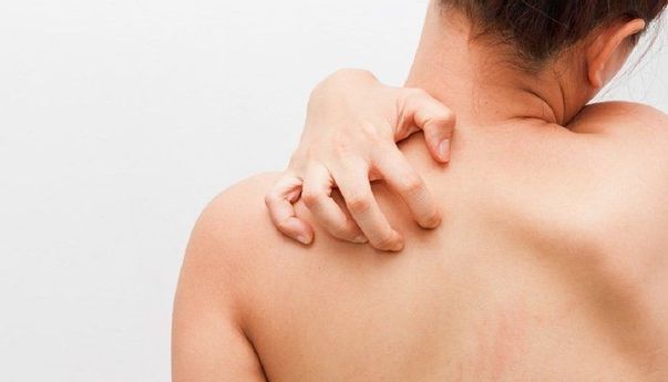 Cara Menghilangkan Panu dengan Bahan Alami, Bikin Kulit Kembali Mulus dan Sehat