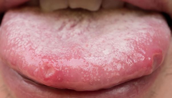 Mengobati Sariawan di Lidah, Begini Caranya!