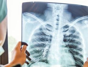 Berita Terbaru: Tracing Penderita TBC di Yogyakarta Terganggu Wabah Corona
